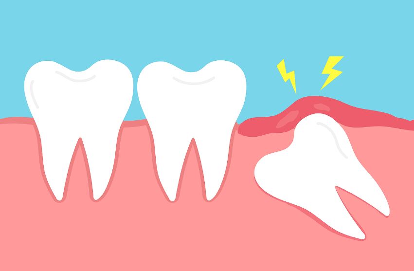 Types of Impacted Wisdom Teeth