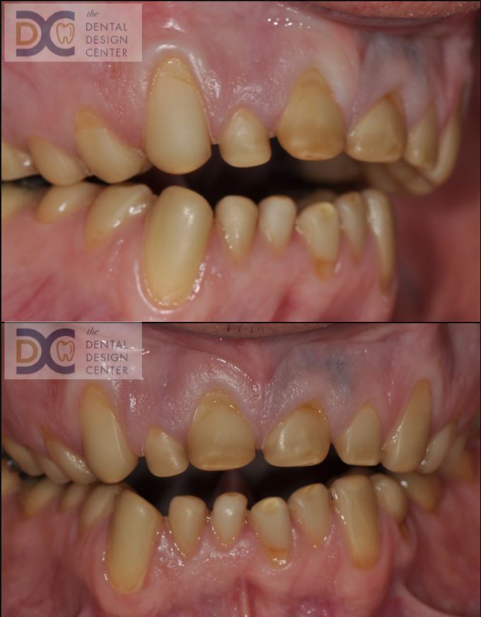 dental tooth wear