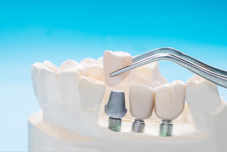 Types of Dental Implants