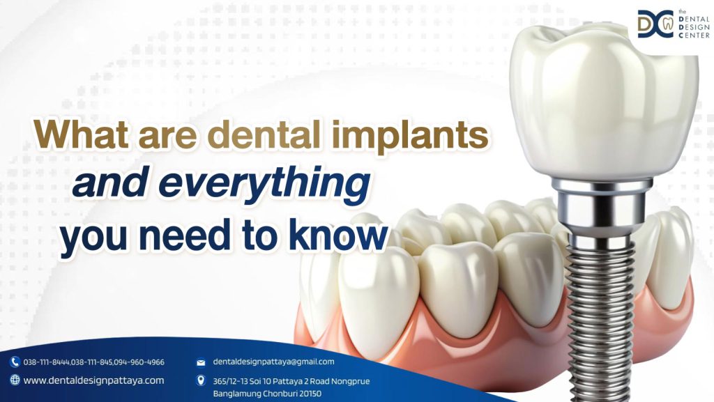 What are dental implants and everything you need to know