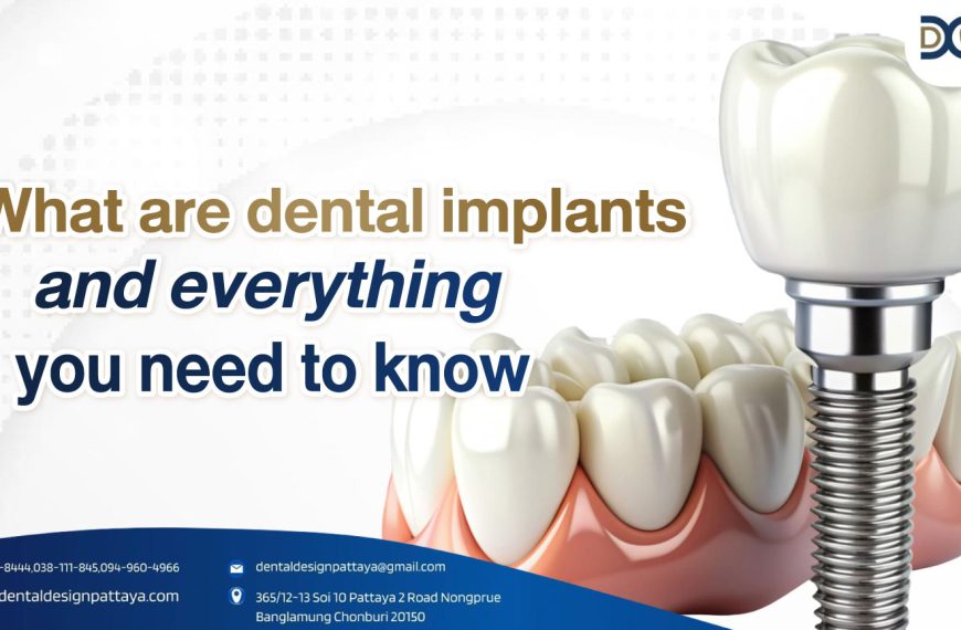 What are dental implants and everything you need to know