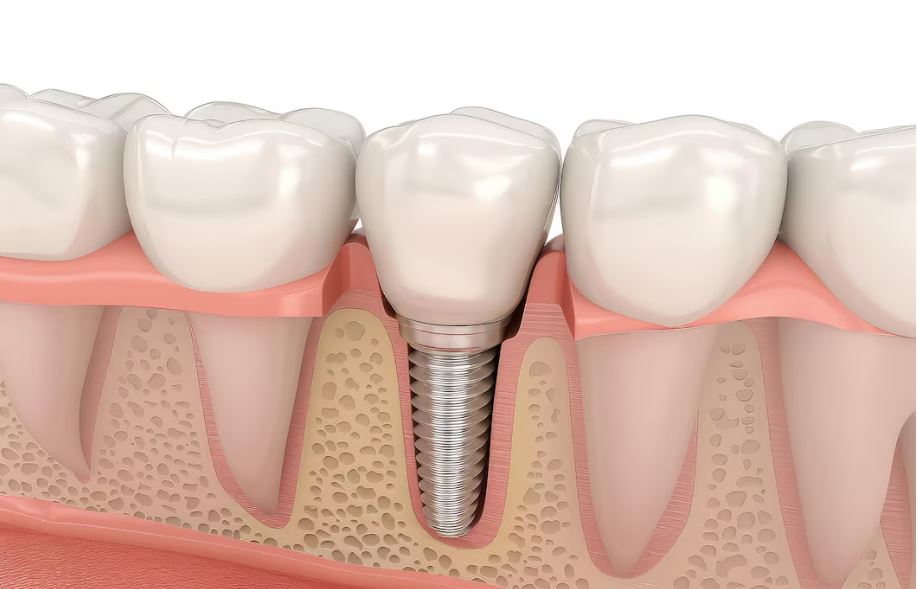 What are dental implants