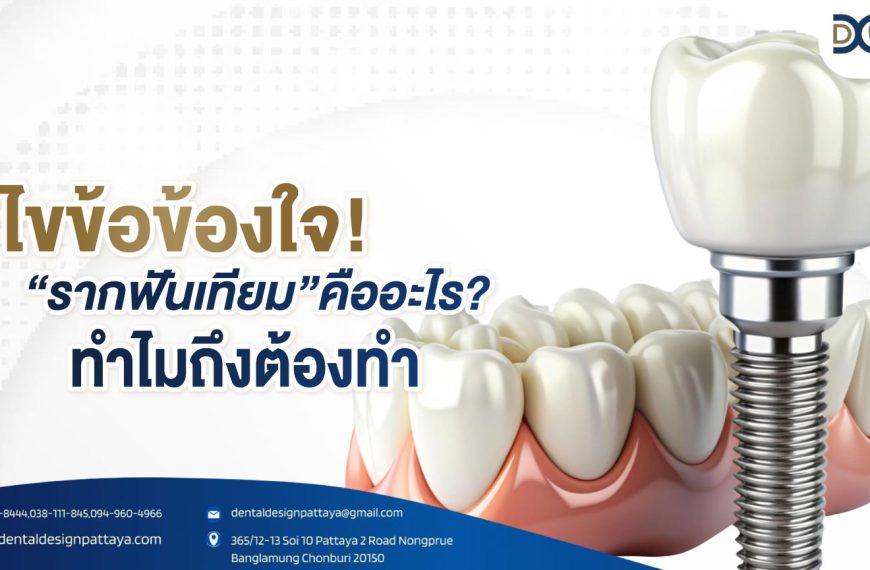 ไขข้อข้องใจ รากฟันเทียมคืออะไร ทำไมถึงต้องทำ