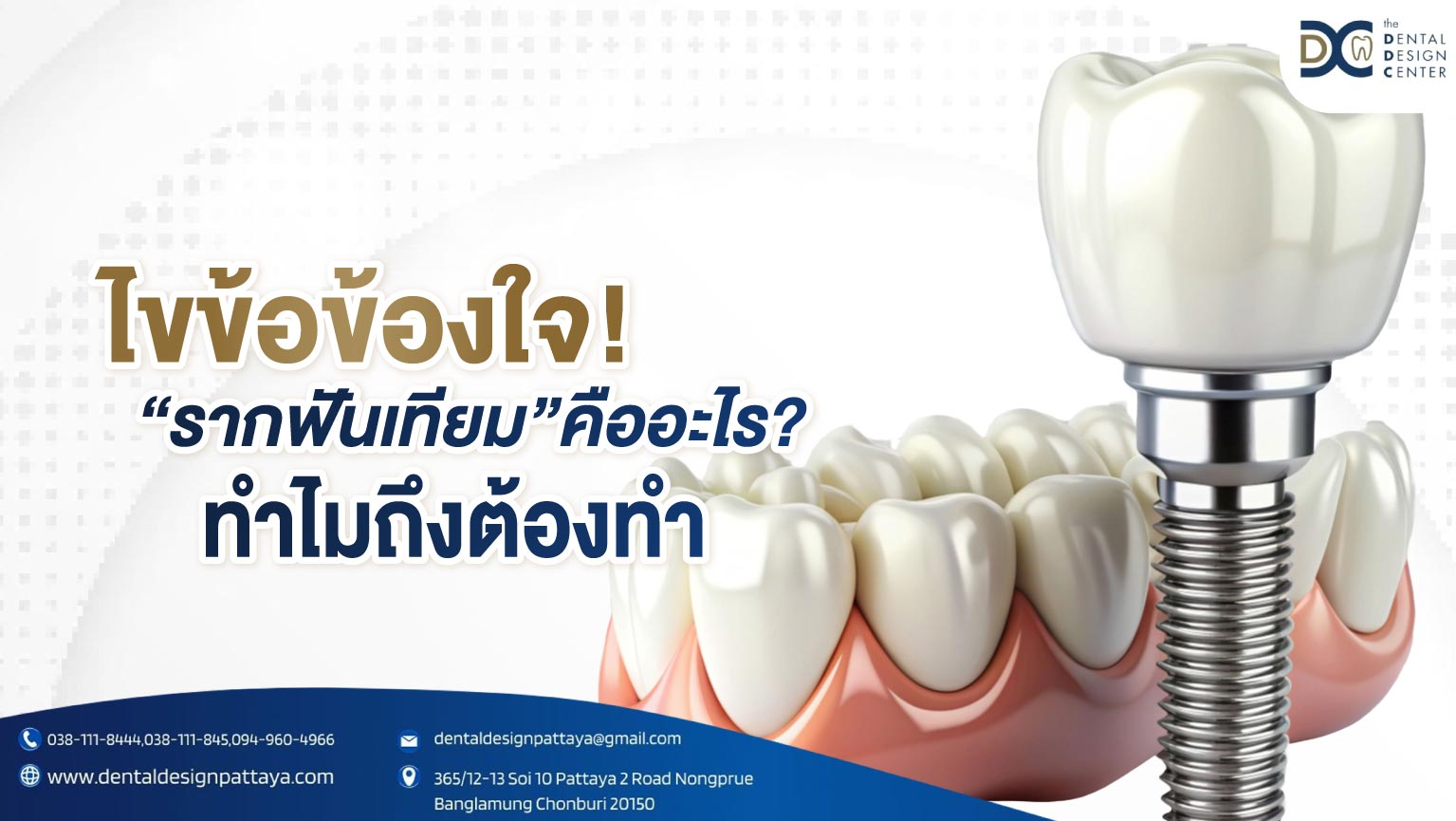 ไขข้อข้องใจ รากฟันเทียมคืออะไร ทำไมถึงต้องทำ