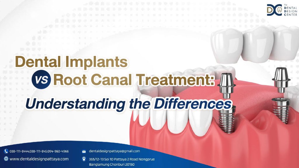 Dental Implants vs. Root Canal Treatment Understanding the Differences