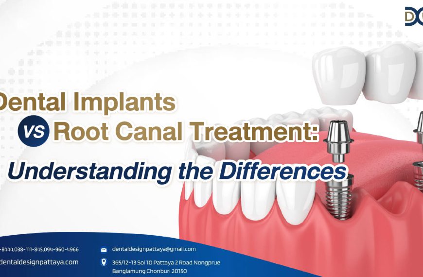 Dental Implants vs. Root Canal Treatment Understanding the Differences