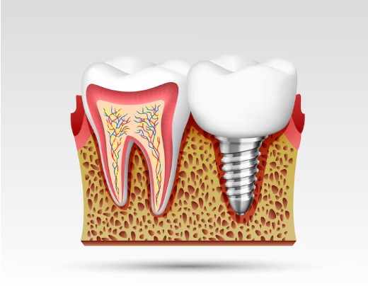 How Dental Implants Work