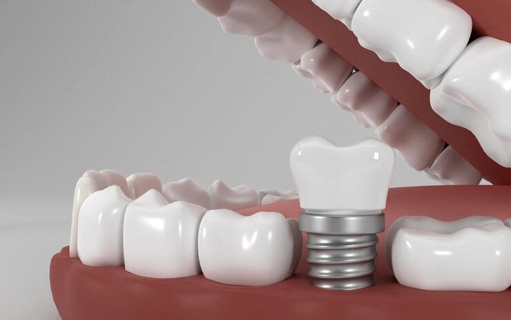 How Long Do Dental Implants Last?