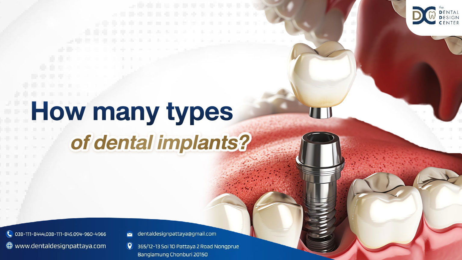 How many types of dental implants