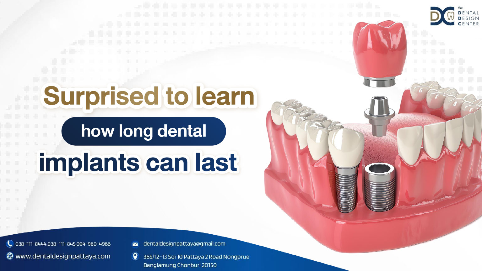 Surprised to learn how long dental implants can last