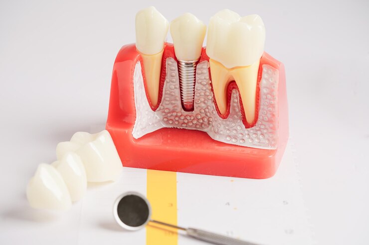 Types of Dental Implants 1