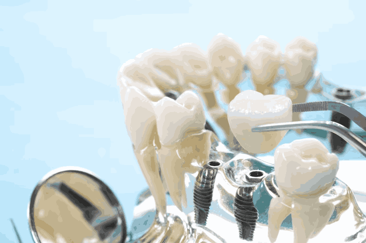 Understanding Dental Implants