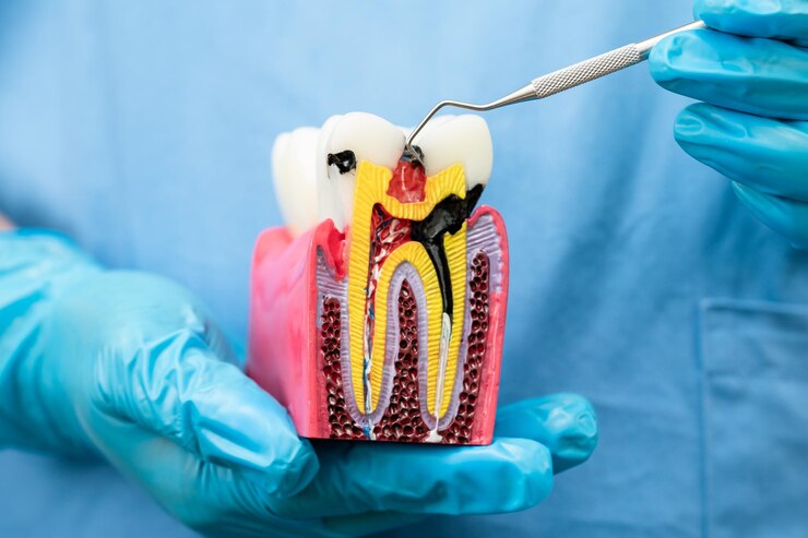 What types of teeth require root canal treatment