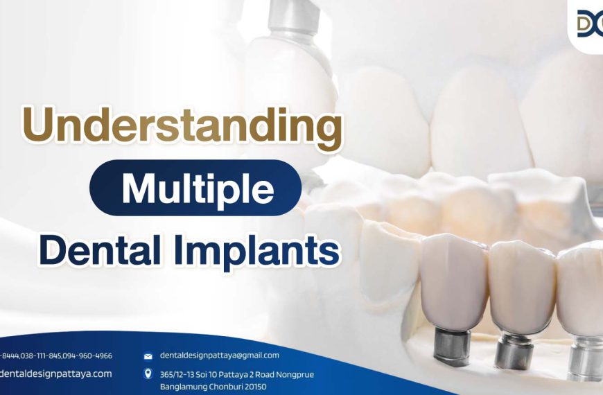 Cover-Multiple Dental Implants