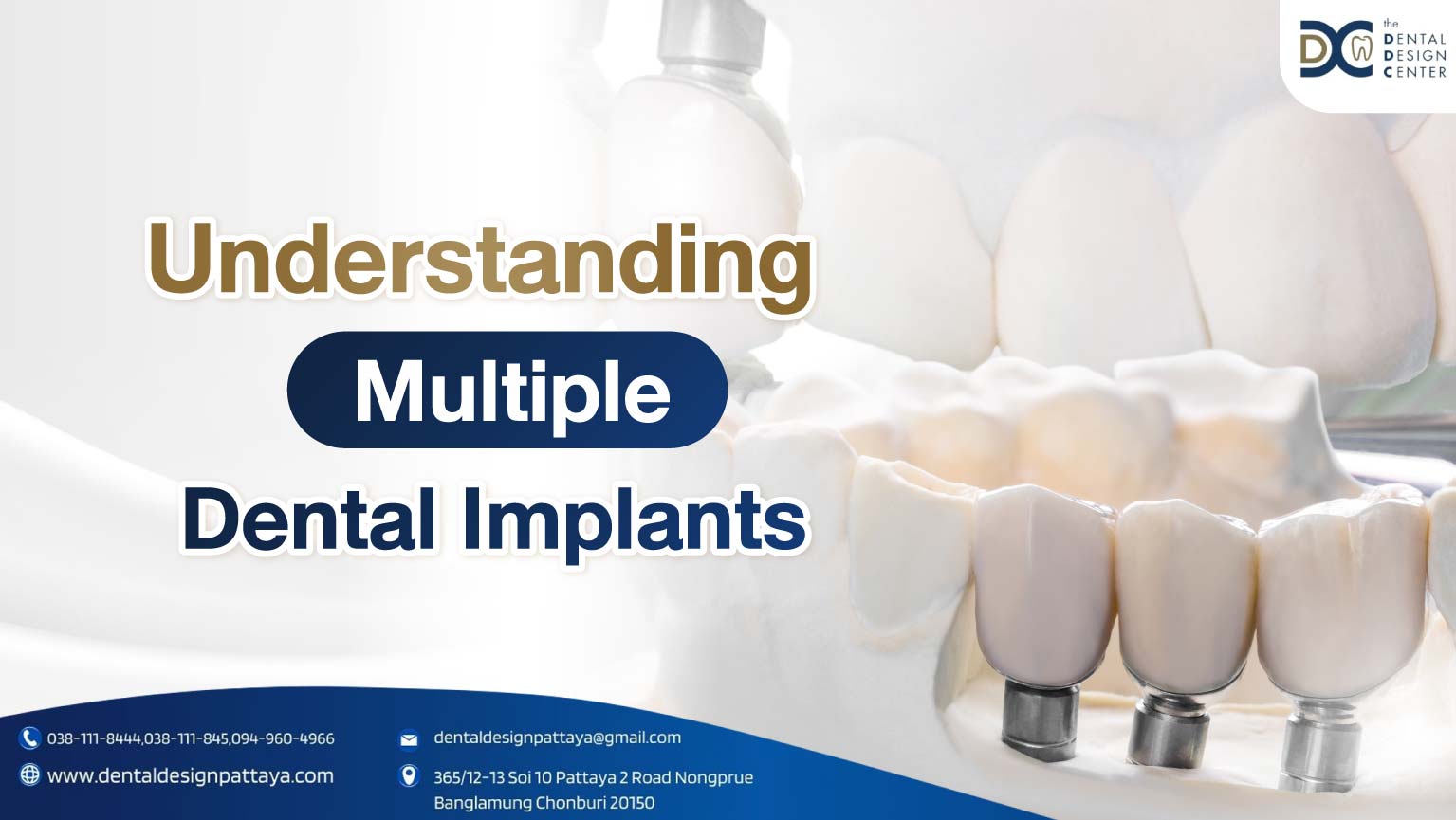 Cover-Multiple Dental Implants