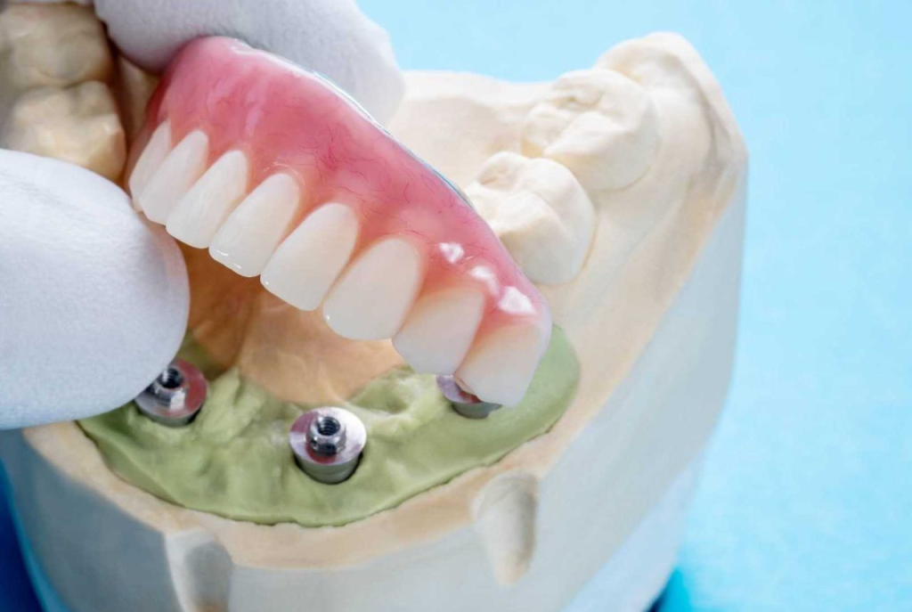 Dental Implant