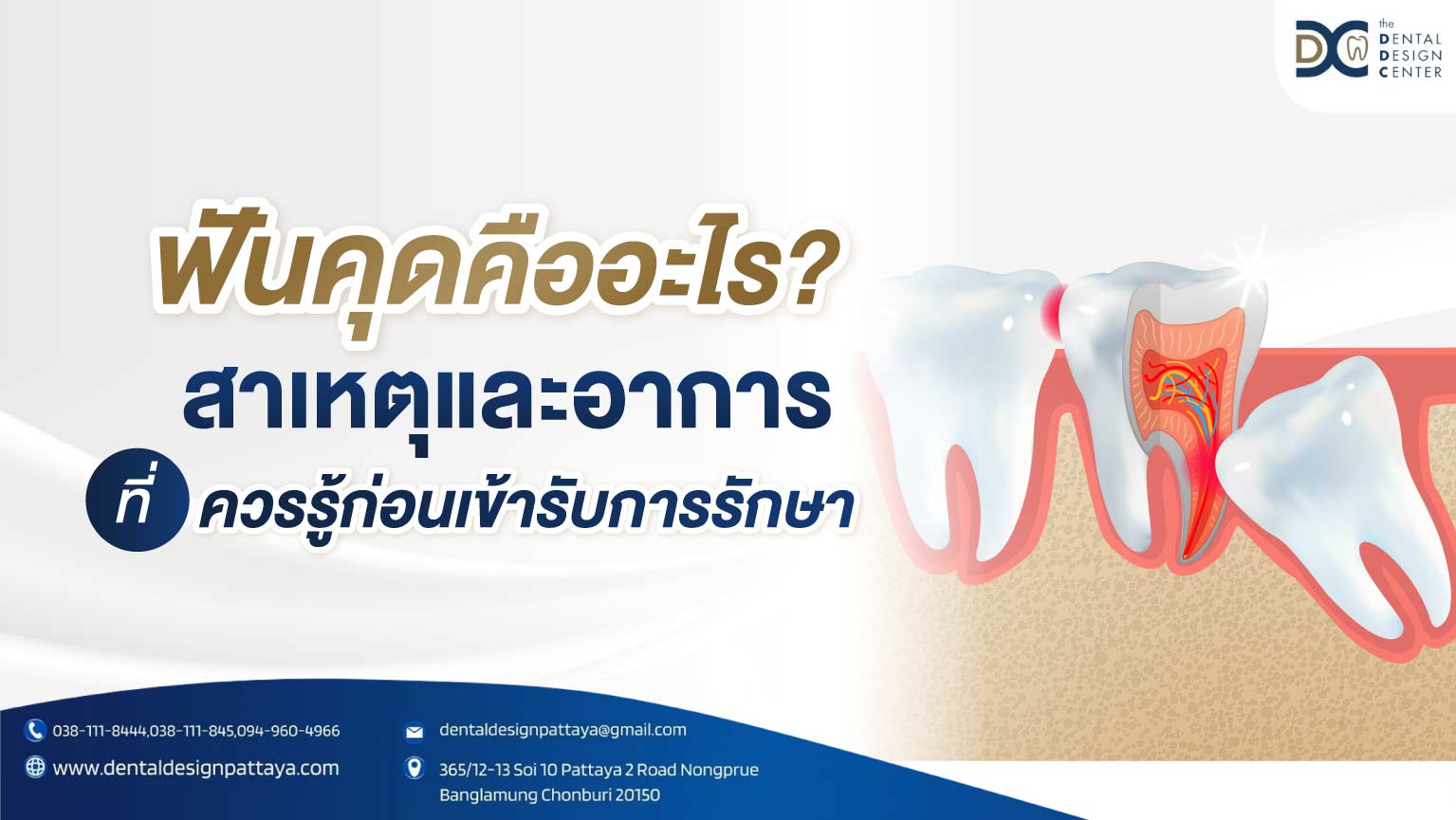 ฟันคุดคืออะไร