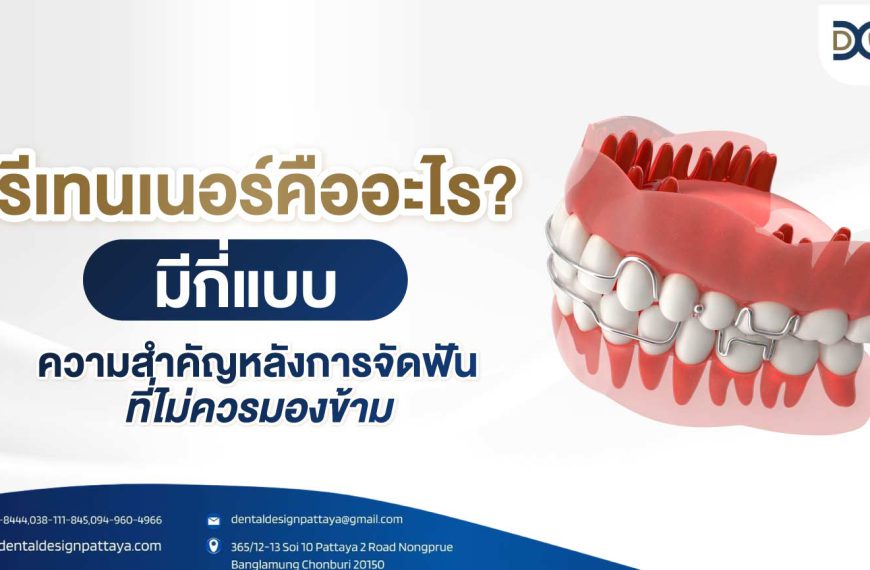 รีเทนเนอร์คืออะไร? มีกี่แบบ ความสำคัญหลังการจัดฟันที่ไม่ควรมองข้าม