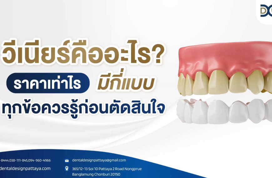 วีเนียร์คืออะไร? ราคาเท่าไร มีกี่แบบ ทุกข้อควรรู้ก่อนตัดสินใจทำ