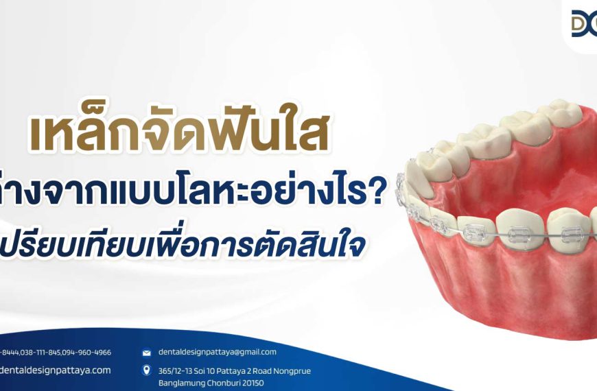 เหล็กจัดฟันใส ต่างจากแบบโลหะอย่างไร? เปรียบเทียบเพื่อการตัดสินใจ