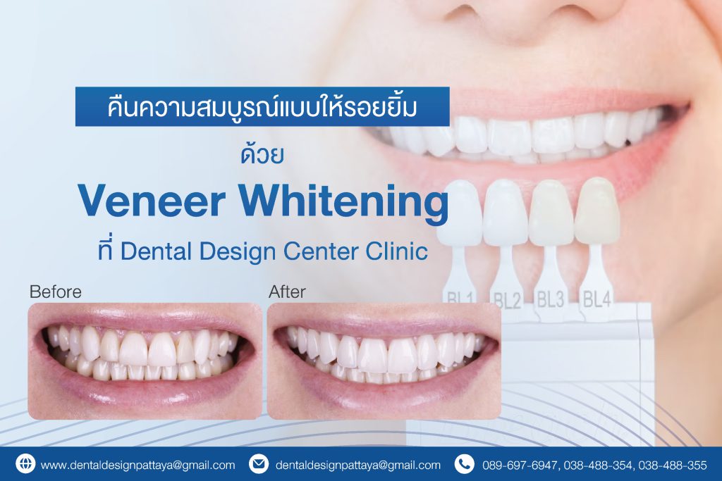 Veneer Whitening in Pattaya – Perfect Your Smile with Dr. Ken Kasidis at Ortho Smile Dental Clinic 1 BANNER ORTHO SMILE 02 01 01