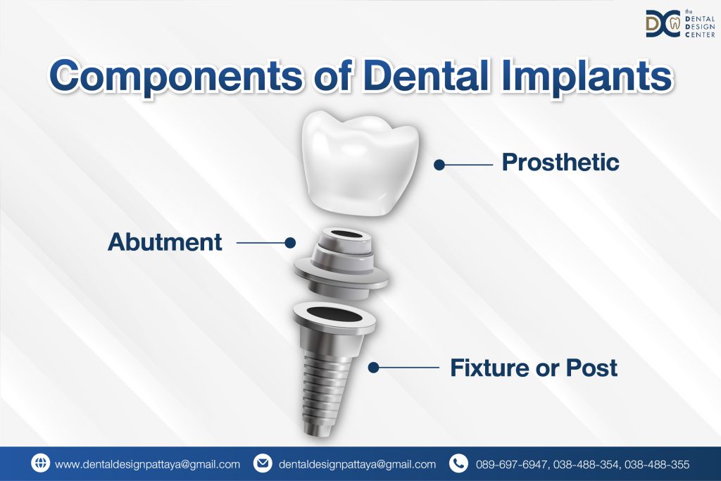 Diagram showing prosthetic, abutment, and fixture of dental implants by Dr. Ken Kasidis at Dental Clinic Pattaya
