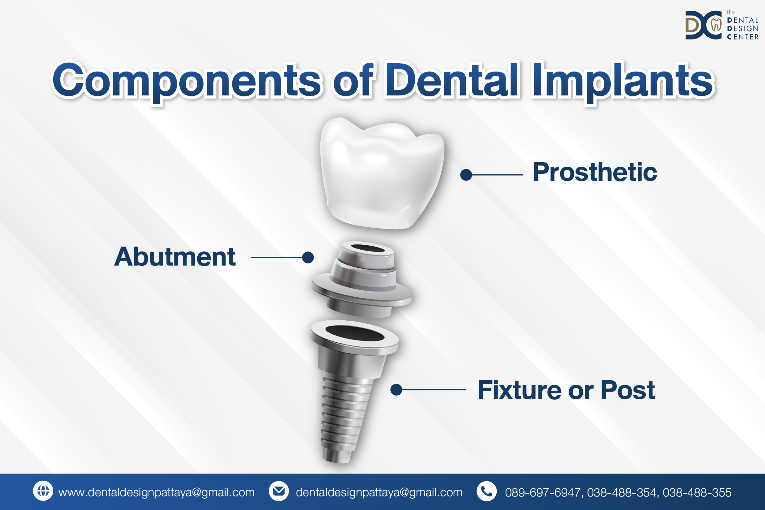 “Diagram showing prosthetic, abutment, and fixture of dental implants by Dr. Ken Kasidis at Dental Clinic Pattaya”