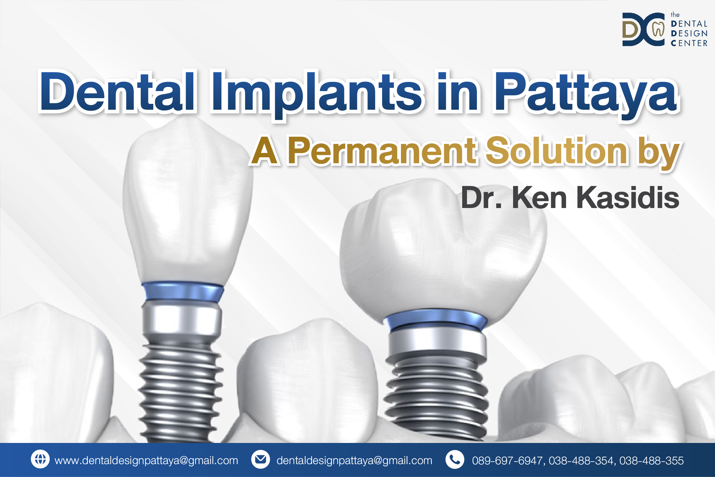 Dental implants in Pattaya by Dr. Ken Kasidis – Permanent tooth replacement at Dental Design Center