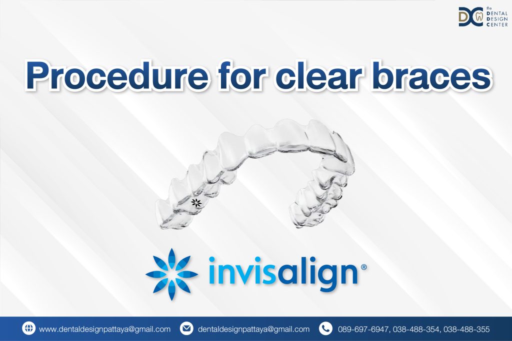 Procedure for Clear Braces (Invisalign) in Pattaya – Your Guide to a Confident Smile 1 Web Procedure for clear braces 01