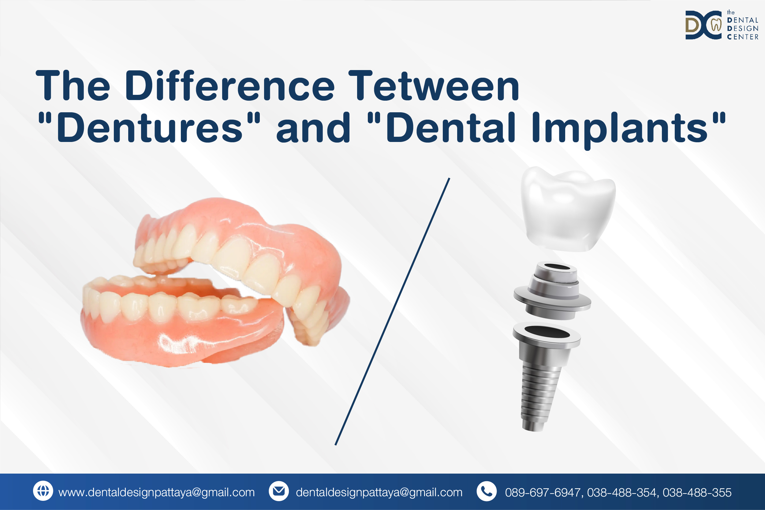 Comparison of dentures and dental implants by Dr. Ken Kasidis – dentist Pattaya