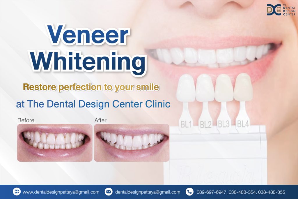 Patient before veneer whitening by Dr. Ken Kasidis, dentist Pattaya