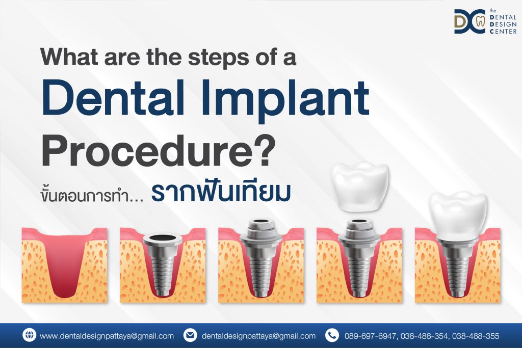 Step-by-Step Dental Implant Procedure in Pattaya – By Dr. Ken Kasidis 1 Web ขั้นตอนการทำรากฟันเทียม 01