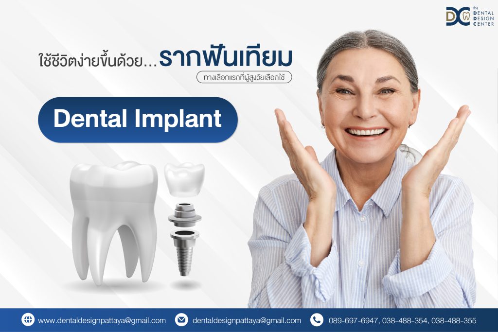 What is a Dental Implant? 1 Web รากฟัน 01