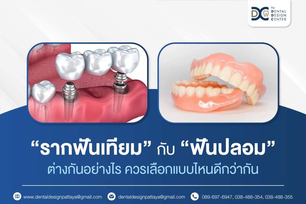 Dental Implants vs Dentures: Which Is the Better Tooth Replacement Option? 1 Web รากฟัน vs ฟันปลอม 01