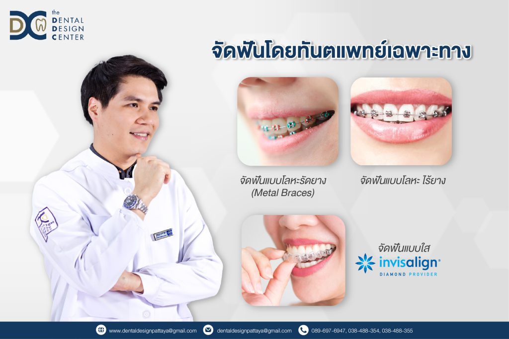Orthodontic Treatment by Specialized Dentists at The Dental Design Center, Pattaya 1 จัดฟันโดนทันตแพทย์เฉพาะทาง 02