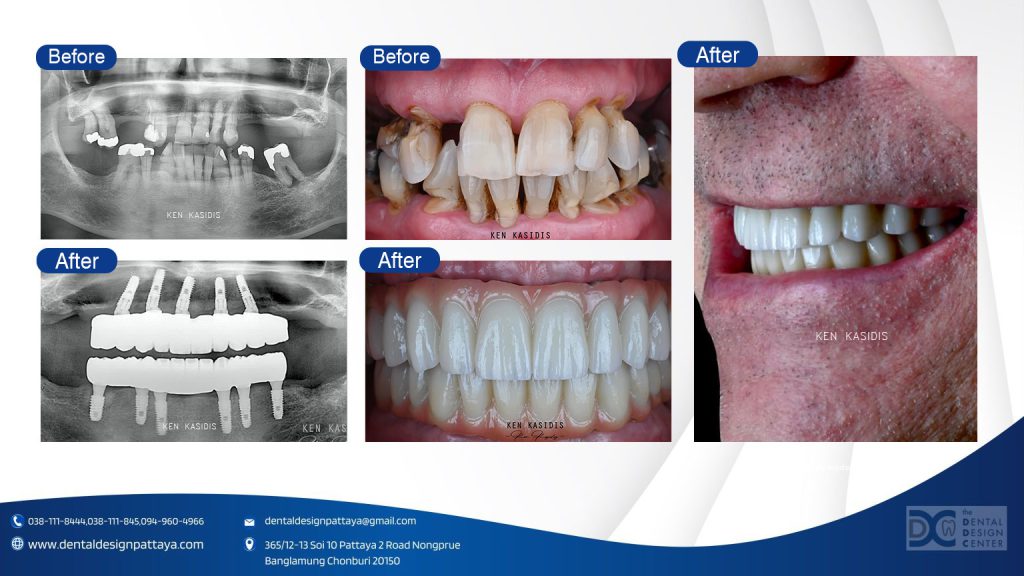Dental Implants in Pattaya: What You Should Know Before Getting One 2 Dental implants Pattaya before and after by Dr. Ken Kasidis