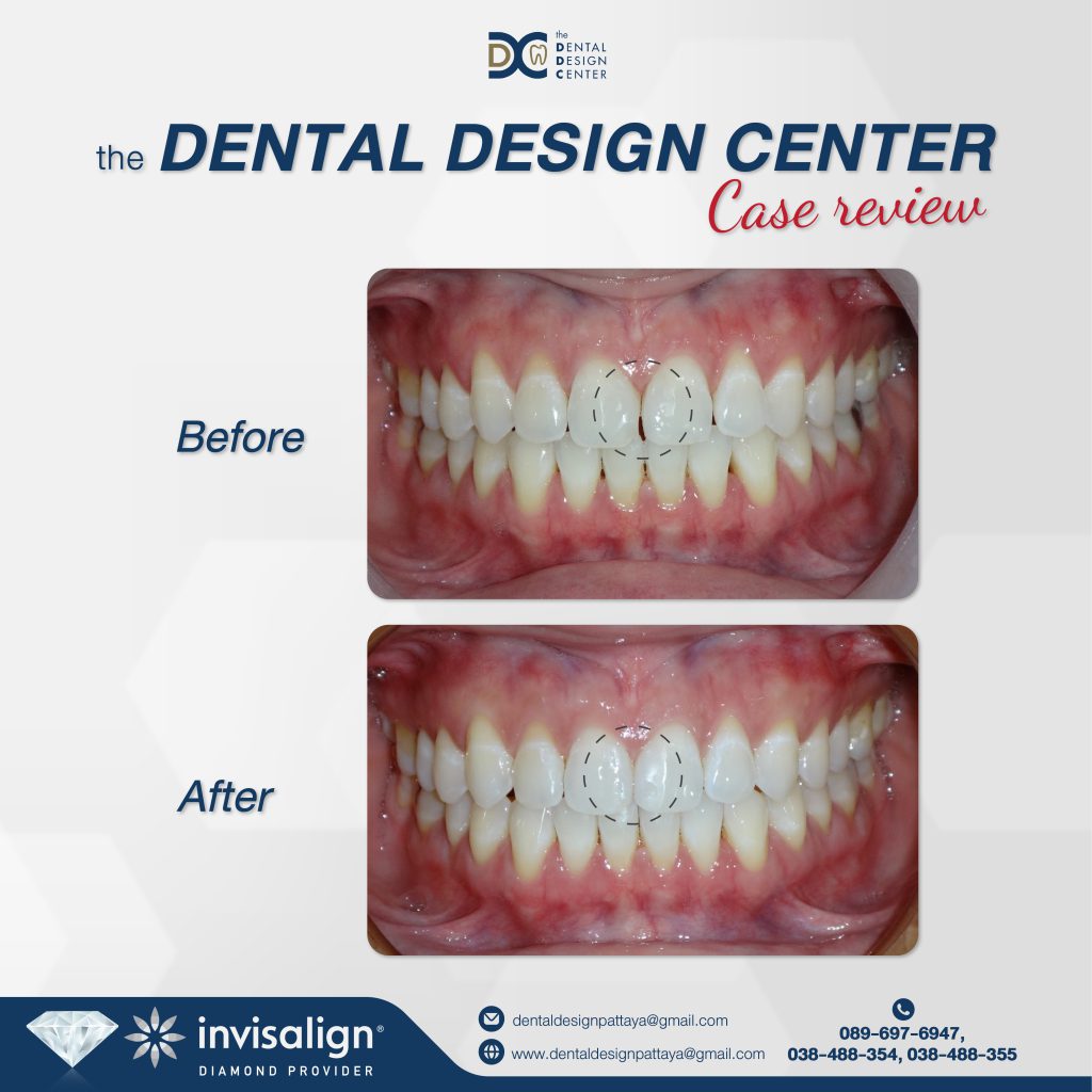 Invisalign patient before and after with Dr. Ken Kasidis at Dental Clinic Pattaya